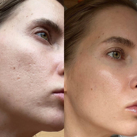 Refine Your Skin: Understanding and Minimizing Enlarged Pores