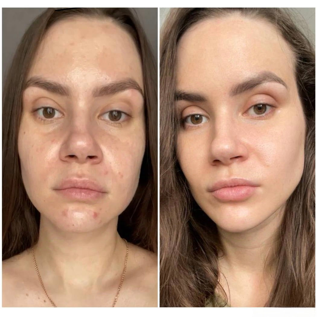 Understanding Puffiness: Causes and Solutions