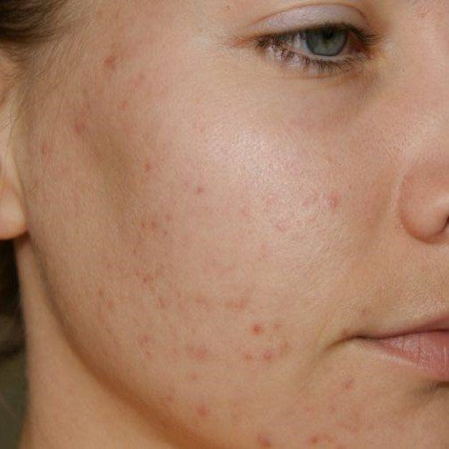 Post-Acne Marks: What Are They and How Do They Differ