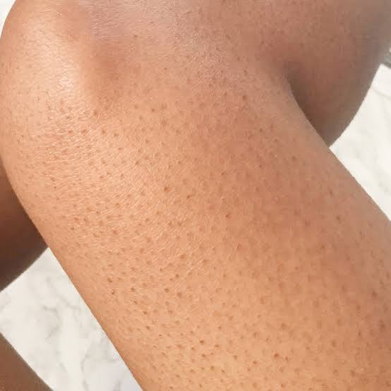 “Strawberry skin”? Discover a new way to smooth, radiant skin