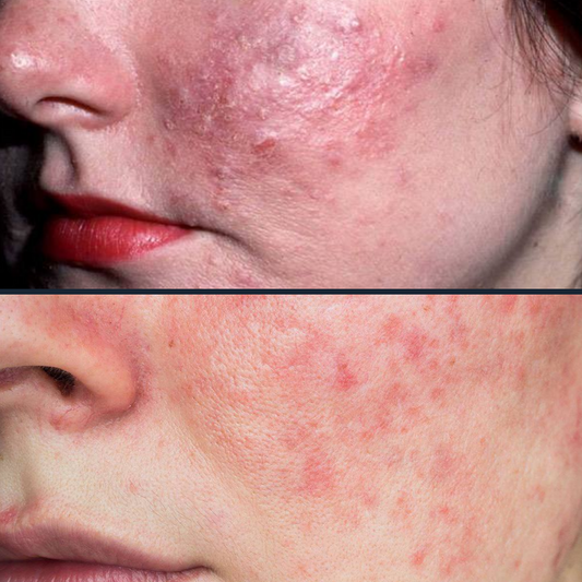 Rosacea. An important and great post