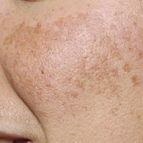 Melasma: Causes and How to Manage It