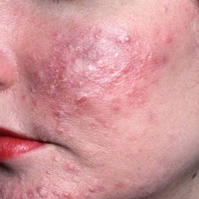 Rosacea. An important and great post