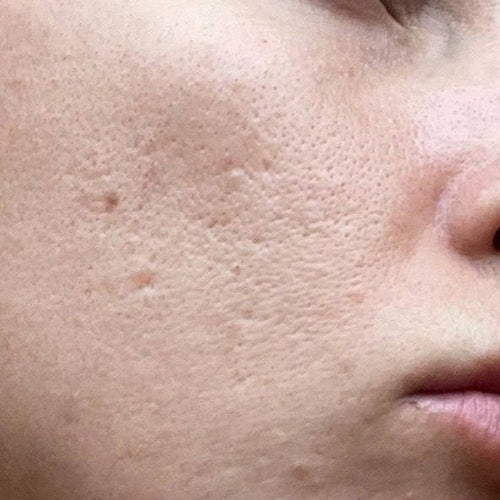 Can You Really Shrink Pores? Here's How